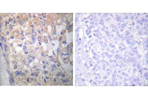P-peptide - +Immunohistochemical analysis of paraffin-embedded human breast carcinoma tissue using Fyn (Phospho-Tyr530) antibody (#A0430). (FYN antibody  (pTyr530))