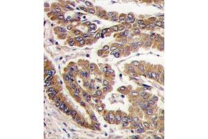 Formalin-fixed and paraffin-embedded human lung carcinoma tissue reacted with PKC zeta antibody (N-term), which was peroxidase-conjugated to the secondary antibody, followed by DAB staining. (PKC zeta antibody  (N-Term))