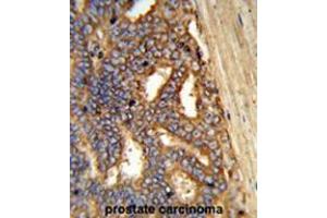 Formalin-fixed and paraffin-embedded human prostate carcinoma reacted with AMY1A Antibody (Center), which was peroxidase-conjugated to the secondary antibody, followed by DAB staining. (Alpha-amylase 1 antibody  (Middle Region))