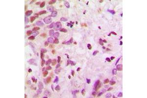 Immunohistochemical analysis of hnRNP A2/B1 staining in human breast cancer formalin fixed paraffin embedded tissue section. (HNRNPA2B1 antibody  (N-Term))