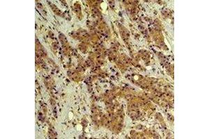 Immunohistochemical analysis of ERK1/2 staining in human breast cancer formalin fixed paraffin embedded tissue section. (ERK1/2 antibody)