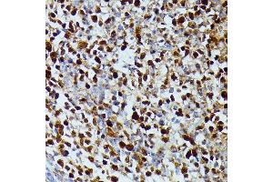 Immunohistochemistry of paraffin-embedded human appendix using DUT antibody (ABIN7266736) at dilution of 1:100 (40x lens). (Deoxyuridine Triphosphatase (DUT) (AA 89-252) antibody)