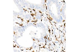 Immunohistochemistry of paraffin-embedded Human colon carcinoma using CD74 antibody (ABIN7267759) at dilution of 1:100 (40x lens). (CD74 antibody)