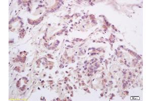 Formalin-fixed and paraffin embedded human gastric carcinoma labeled with Rabbit Anti OPGL/RANKL/ODF Polyclonal Antibody, Unconjugated (ABIN672696) at 1:200 followed by conjugation to the secondary antibody and DAB staining (RANKL antibody  (AA 210-317))