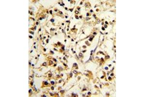 Formalin-fixed and paraffin-embedded human breast carcinoma reacted with CD158d / KIR2DL4 Antibody (C-term) followed which was peroxidase-conjugated to the secondary antibody, followed by DAB staining. (KIR2DL4/CD158d antibody  (C-Term))