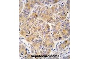 Formalin-fixed and paraffin-embedded human hepatocarcinoma tissue reacted with ALDH9A1 antibody (C-term), which was peroxidase-conjugated to the secondary antibody, followed by DAB staining. (ALDH9A1 antibody  (C-Term))