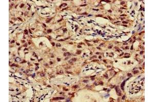 Immunohistochemistry of paraffin-embedded human lung cancer using ABIN7144675 at dilution of 1:100 (NAT1 antibody  (AA 1-288))