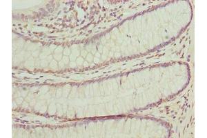 Immunohistochemistry of paraffin-embedded human colon cancer using ABIN7165150 at dilution of 1:100 (BUD31 antibody  (AA 1-144))
