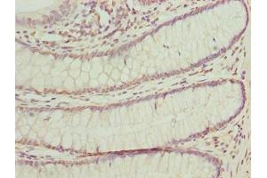 Immunohistochemistry of paraffin-embedded human colon cancer using ABIN7165150 at dilution of 1:100