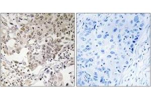 Immunohistochemistry analysis of paraffin-embedded human lung carcinoma, using NCAPG2 Antibody. (NCAPG2 antibody  (AA 561-610))