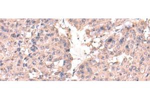 Immunohistochemistry of paraffin-embedded Human liver cancer tissue using HPN Polyclonal Antibody at dilution of 1:50(x200) (Hepsin antibody)