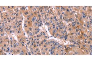 Immunohistochemistry of paraffin-embedded Human liver cancer using CD269 Polyclonal Antibody at dilution of 1:30 (BCMA antibody)
