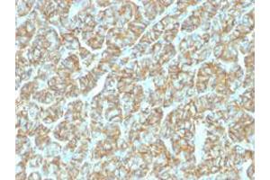 Immunohistochemical staining (Formalin-fixed paraffin-embedded sections) of human thyroid carcinoma with EPCAM recombinant monoclonal antibody, clone EGP40/1555R . (Recombinant EpCAM antibody  (AA 20-60))