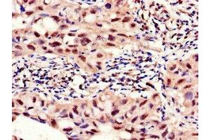 Immunohistochemistry of paraffin-embedded human lung cancer using ABIN7142693 at dilution of 1:100 (PFKFB2 antibody  (AA 360-505))