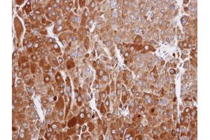 IHC-P Image Immunohistochemical analysis of paraffin-embedded human adrenal cortical tumor, using RIC8A, antibody at 1:100 dilution.