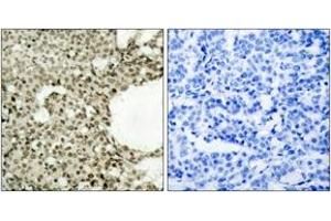 Immunohistochemistry analysis of paraffin-embedded human breast carcinoma, using STAT1 (Phospho-Ser727) Antibody.