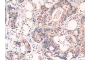 IHC-P analysis of Human Rectum Cancer Tissue, with DAB staining. (POR antibody  (AA 77-518))