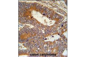MAP1S Antibody immunohistochemistry analysis in formalin fixed and paraffin embedded human colon carcinoma followed by peroxidase conjugation of the secondary antibody and DAB staining. (MAP1S antibody  (AA 493-520))