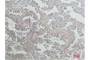 Immunohistochemistry (IHC) analysis of paraffin-embedded Human Lung Carcinoma using Nrf2 Rabbit Polyclonal Antibody diluted at 1:200. (NRF2 antibody)