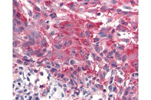 Anti-FZD4 / Frizzled 4 antibody IHC of human Skin, Melanoma. (FZD4 antibody  (C-Term))