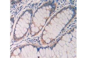 IHC-P analysis of rectum cancer tissue, with DAB staining.