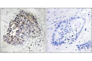 Immunohistochemistry analysis of paraffin-embedded human lung carcinoma tissue, using Cytochrome P450 2S1 Antibody. (CYP2S1 antibody  (AA 181-230))