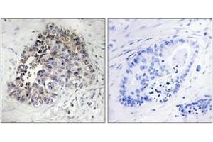 Immunohistochemistry analysis of paraffin-embedded human lung carcinoma tissue, using Cytochrome P450 2S1 Antibody.