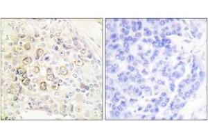 Immunohistochemistry analysis of paraffin-embedded human breast carcinoma tissue, using HER3 Antibody. (ERBB3 antibody  (AA 1-50))