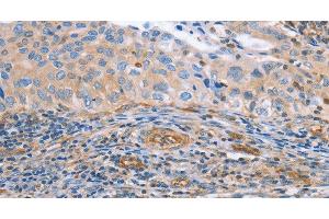 Immunohistochemistry of paraffin-embedded Human cervical cancer tissue using NRG4 Polyclonal Antibody at dilution 1:60 (Neuregulin 4 antibody)