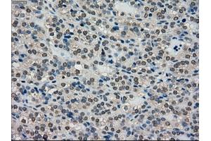 Immunohistochemical staining of paraffin-embedded Adenocarcinoma of breast tissue using anti-SCYL3 mouse monoclonal antibody. (SCYL3 antibody)