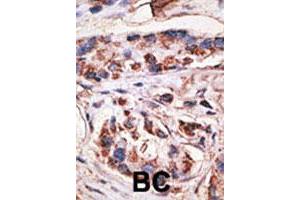 Formalin-fixed and paraffin-embedded human breast cancer tissue reacted with MAGEA1 polyclonal antibody  , which was peroxidase-conjugated to the secondary antibody, followed by DAB staining.