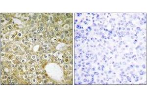 Immunohistochemistry analysis of paraffin-embedded human breast carcinoma tissue, using ACVL1 Antibody. (ACVRL1 antibody  (AA 196-245))