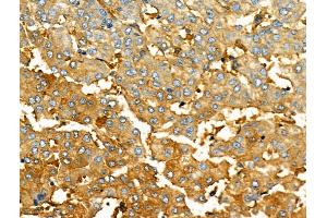ABIN6261825 and ABIN6276547 at 1/100 staining Human liver cancer by IHC-P.