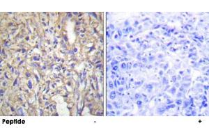 Immunohistochemistry analysis of paraffin-embedded human liver carcinoma tissue using LAMB1 polyclonal antibody . (Laminin beta 1 antibody  (C-Term))