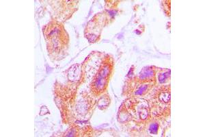 Immunohistochemical analysis of DNAJB11 staining in human lung cancer formalin fixed paraffin embedded tissue section.
