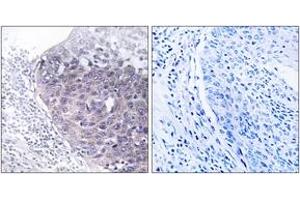 Immunohistochemistry analysis of paraffin-embedded human cervix carcinoma tissue, using GTPBP5 Antibody. (GTPBP5 antibody  (AA 71-120))