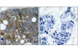 Immunohistochemistry analysis of paraffin-embedded human breast carcinoma, using HSP27 (Phospho-Ser15) Antibody. (HSP27 antibody  (pSer15))