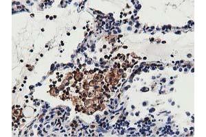 Immunohistochemical staining of paraffin-embedded Carcinoma of Human lung tissue using anti-MICAL1 mouse monoclonal antibody.