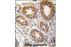 Formalin-fixed and paraffin-embedded human hepatocarcinoma tissue reacted with AHCY antibody (N-term) (ABIN389201 and ABIN2839361) , which was peroxidase-conjugated to the secondary antibody, followed by DAB staining. (AHCY antibody  (N-Term))