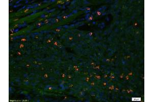 Formalin-fixed and paraffin embedded Human oral squamous cell carcinoma labeled with Anti-Caspase-3 Polyclonal Antibody, Unconjugated (ABIN724625) at 1:200 followed by conjugation to the secondary antibody Goat Anti-Rabbit IgG, PE conjugated used at 1:200 dilution for 40 minutes at 37°C and DAPI staining (Caspase 3 antibody  (AA 60-100))