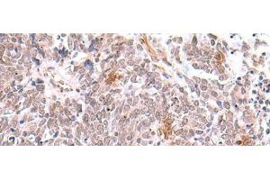 Immunohistochemistry of paraffin-embedded Human lung cancer tissue using INPP5K Polyclonal Antibody at dilution of 1:90(x200) (INPP5K antibody)