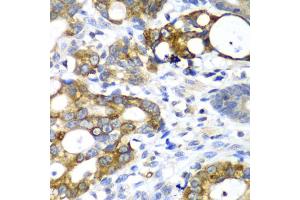 Immunohistochemistry of paraffin-embedded human gastric cancer using AMY2A antibody. (AMY2A antibody)