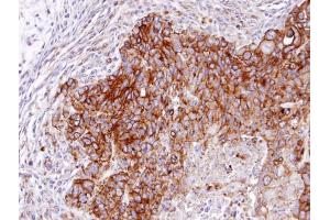IHC-P Image Immunohistochemical analysis of paraffin-embedded SW480 xenograft, using RASGRP4 , antibody at 1:100 dilution. (RASGRP4 antibody  (N-Term))