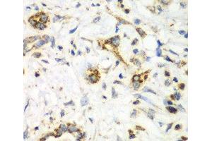 Immunohistochemistry of paraffin-embedded Human liver cancer using NRBF2 Polyclonal Antibody at dilution of 1:100 (40x lens). (NRBF2 antibody)