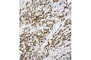 Anti-DCI antibody, IHC(P) IHC(P): Human Mammary Cancer Tissue (DCI antibody  (C-Term))