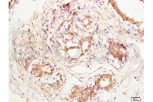 Formalin-fixed and paraffin embedded human breast carcinoma labeled with Anti-CD144/VECD/VE Cadherin Polyclonal Antibody, Unconjugated (ABIN729343) at 1:200, followed by conjugation to the secondary antibody and DAB staining (Cadherin 5 antibody  (AA 601-700))