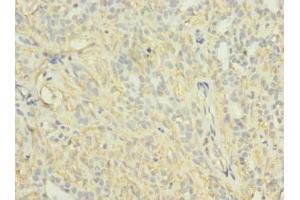 Immunohistochemistry of paraffin-embedded human breast cancer using ABIN7163997 at dilution of 1:100