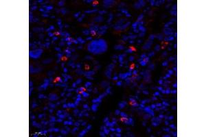 Immunofluorescence of paraffin embedded human lung cancer using MTND5 (ABIN7074659) at dilution of 1: 400 (450x lens) (MT-ND5 antibody)