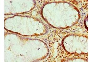 Immunohistochemistry of paraffin-embedded human colon cancer using ABIN7161681 at dilution of 1:100 (HMGN2 antibody  (AA 1-90))