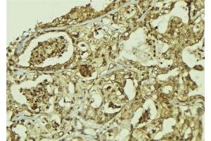 ABIN6273301 at 1/100 staining Human breast cancer tissue by IHC-P.